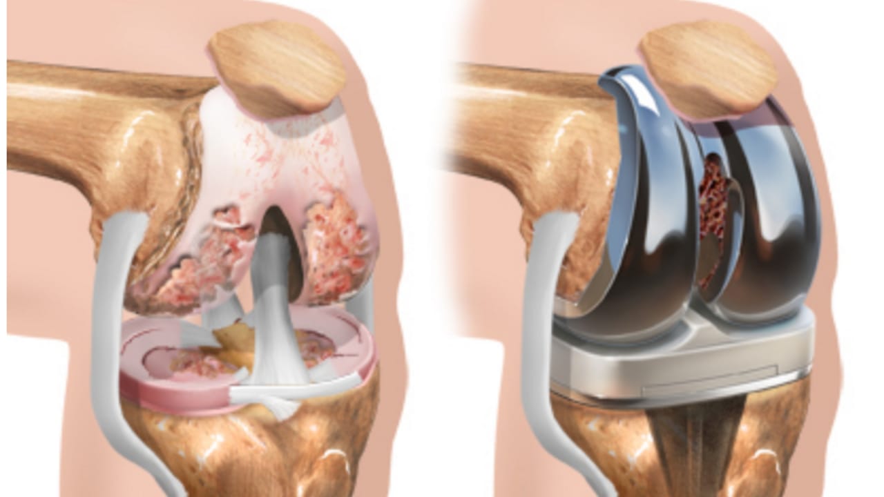 Understanding the Hidden Challenges of Total Knee Arthroplasty